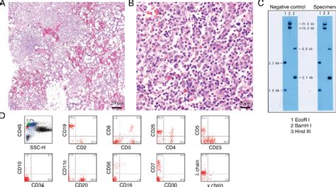 Figure From Successful Treatment Of Severe Splenic Lymphoma