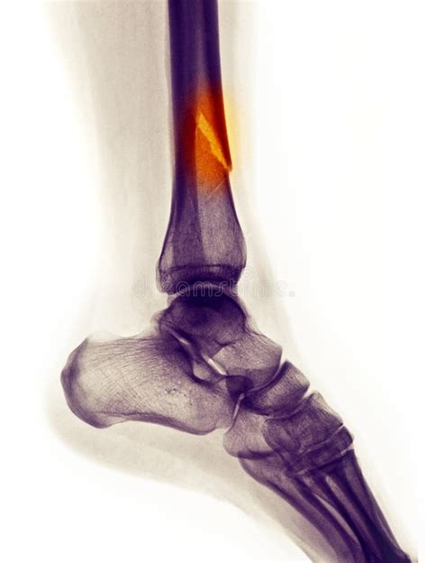 Lower leg fracture stock photo. Image of injury, trauma - 19294748