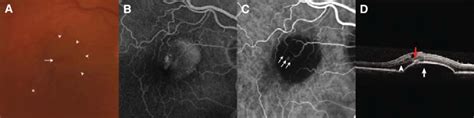 Retinal Angiomatous Proliferation Rap A Color Fundus Photograph