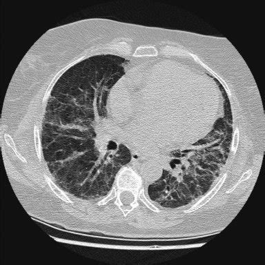 (PDF) Death by bleomycin pulmonary toxicity in ovarian dysgerminoma with pathologic complete ...