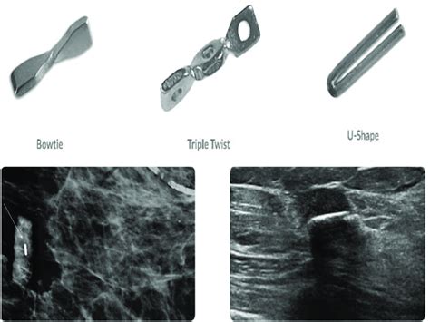 Mammomark Cormark Biopsy Clips In Their Native Forms A And After Clip