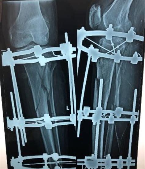 Preoperative X Ray Of A Patient Download Scientific Diagram