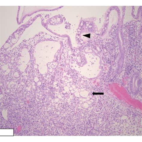 Invasive Signet Ring Cell Carcinoma Of The Ileum Arrow Arising From