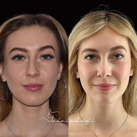 Rhinoplasty Beverly Hills Nose Surgery Dr Charles Galanis