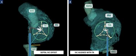 Computed Tomography Anatomic Predictors Of Outcomes In Patients