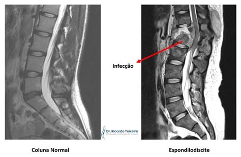 Espondilodiscite Infecção da Coluna Vertebral