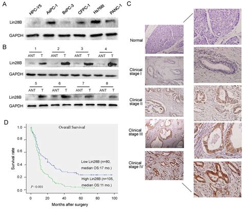 Lin28B Expression Is Upregulated In PDAC Cell Lines And Primary Human