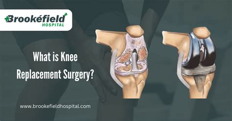 What Is Knee Replacement Surgery