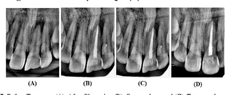 Figure 1 From Evaluation Of Root Canal Treatment In Chronic Periapical Abscess Of Central