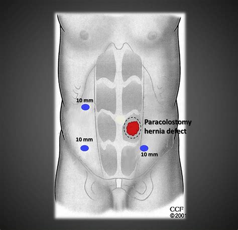 A New Combined Technique Of Reinforced Parastomal Hernia Repair