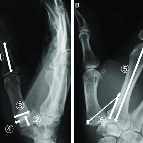 Pdf Radiographic Evaluation After Arthroscopic Partial Trapeziectomy