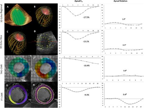 Libman-Sacks Endocarditis: Detection, Characterization, and Clinical ...