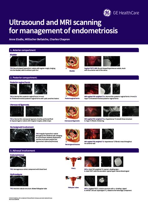 Gynecology Ultrasound Gyn Poster Voluson Ultrasound