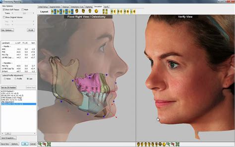 3D Visual Treatment Objective VTO Software Demo YouTube