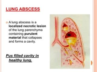 Lung Abscess Cause Symptoms Treatment