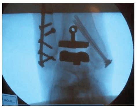 Total Ankle Arthroplasty Rehabilitation Musculoskeletal Key