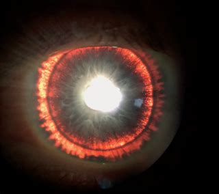 Man's 'Glowing' Iris Was a Sign of Rare Eye Syndrome | Live Science