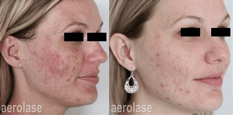 Neoclear Acne Laser Treatment Near Me - babyacnearticles