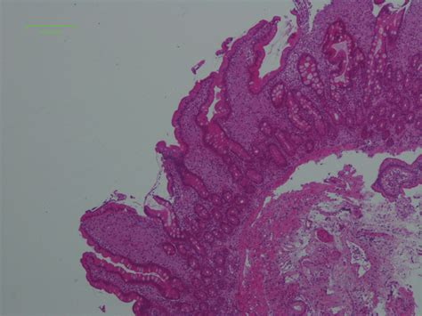 Duodenal Mucosa Section Showing Villi Distorted By Macrophage