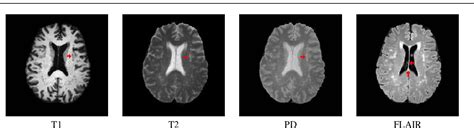 Figure 1 From Multiple Sclerosis Lesion Segmentation Using Statistical And Topological Atlases