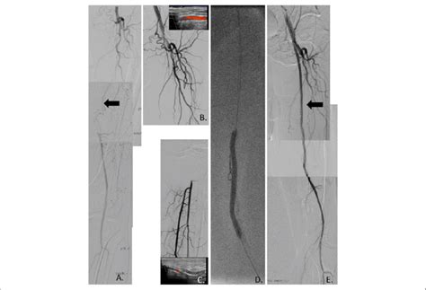 A Digital Subtraction Angiography Shows Chronic Total Occlusion Of Download Scientific