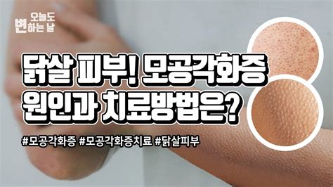 닭살피부 모공각화증 원인과 치료방법이 있나요 Youtube