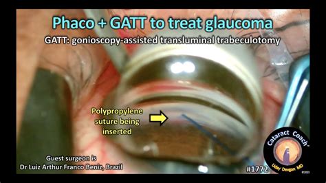 Cataractcoach Phaco And Gatt Glaucoma Surgery Youtube