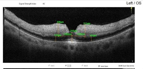 Shows Disorganized Hyperreflective Inner Retinal Layers With Increased