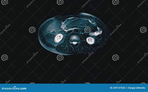 TAC A Colori Voluminosa Dell Addome Tomografia Computerizzata Del