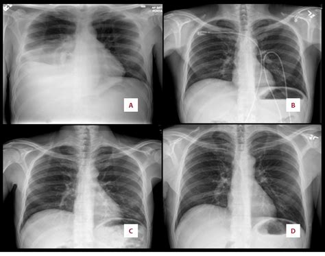 Figure From Recurrent Pleural Effusion Secondary To A Pancreatic