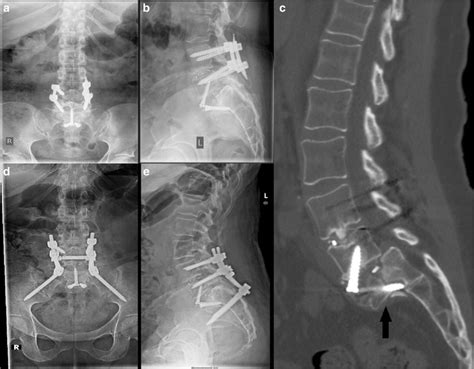 A Anteroposterior Ap And B Lateral Plain Radiographs Taken Before