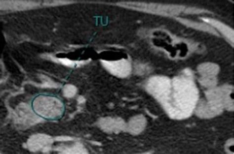 Improving Prognostic Value Of Ct Deep Radiomic Features In Pancreatic Ductal Adenocarcinoma