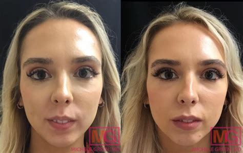 Lip Flip Vs Lip Fillers Compare Lip Procedures Dr Michele Green M D