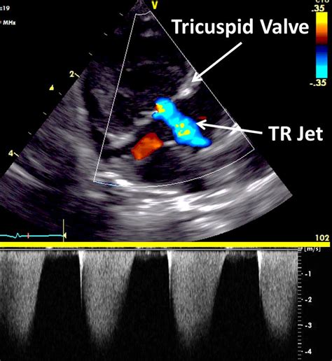 Tr Jet And Corresponding Cwd Image The Upper Panel Demonstrates The