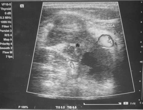 Ultrasound Of Neck Showing Sol Lymphnode Breaching The Wall Of Ijv Download Scientific