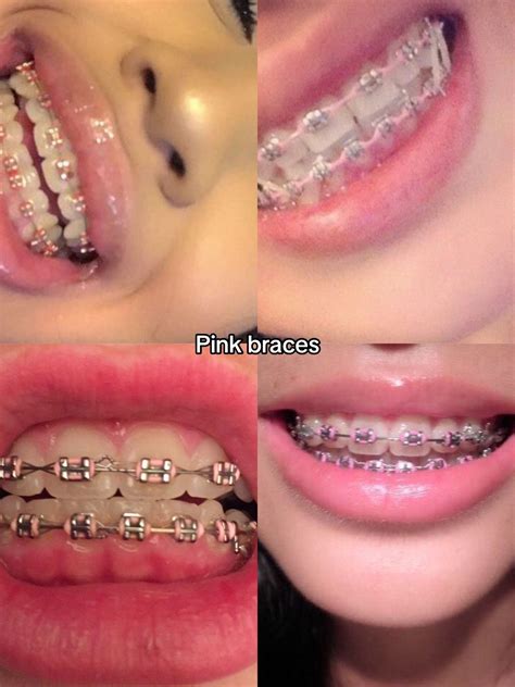 Tiktok Make Your Day Braces Colors Cute Braces Colors Getting Braces