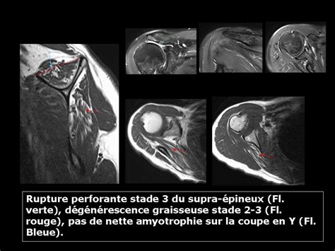 Les Lésions De La Coiffe Des Rotateurs Imagerie De L Appareil Locomoteur