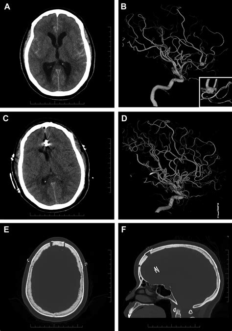 Minimally Invasive And Outpatient Aneurysm Surgery Neurosurgery Clinics