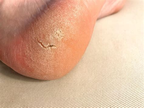 Treating Calluses Glendale Az Sole Foot And Ankle Specialists