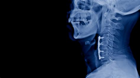 Cervical Discectomy Surgery IMAGE 1 Neurosurgeons Of New Jersey