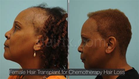 41 African American Hair Transplant Atlanta Narindardarsh