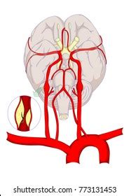 Cerebral Infarct Images Stock Photos Vectors Shutterstock