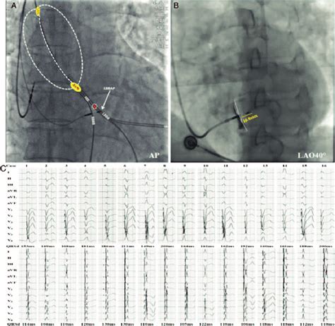 Left Bundle Branch Area Pacing Procedure And Results A A Lead