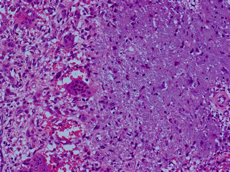 Phosphaturic Mesenchymal Tumor Pmt Of Mixed Connective Tissue Type