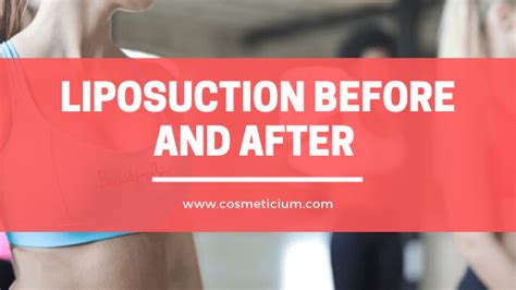 Liposuction Before and After - Incredible Changes | Cosmeticium