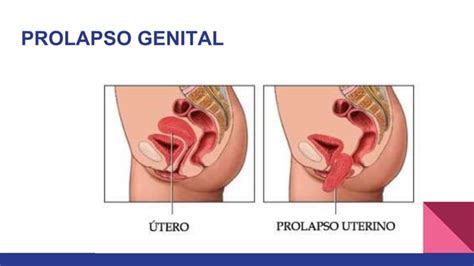 Incontinencia Urinaria Ppt Descarga Gratuita