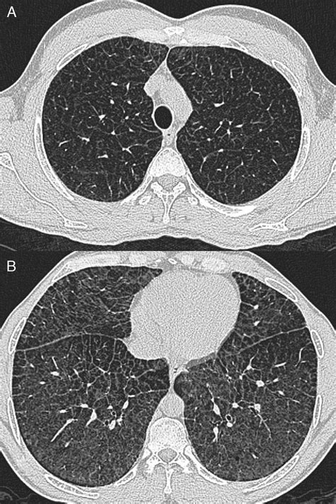 Lung Affectation In An Adult Patient With Niemann Pick Disease Type B