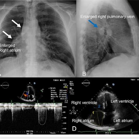 A Posteroanterior And B Lateral Chest Radiograph Demonstrating An