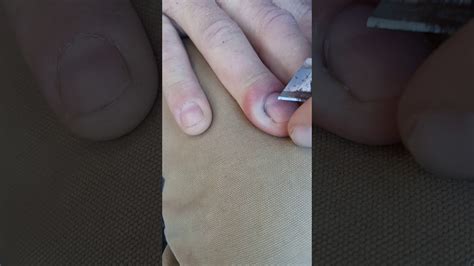 Infected Cuticle On Finger Paronychia Youtube