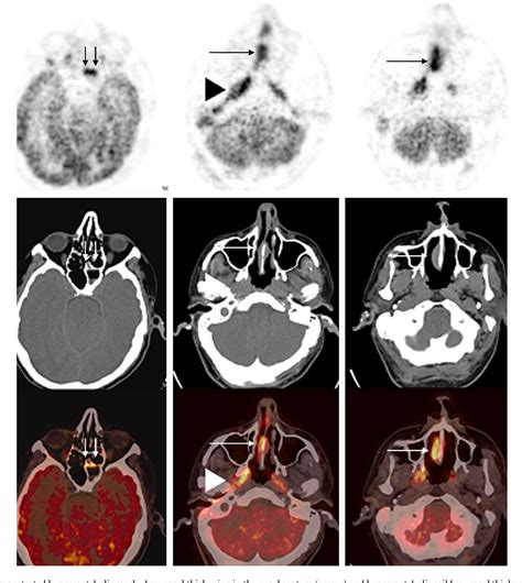 Intense FDG Uptake On PET CT In The Upper And Lower Respiratory System